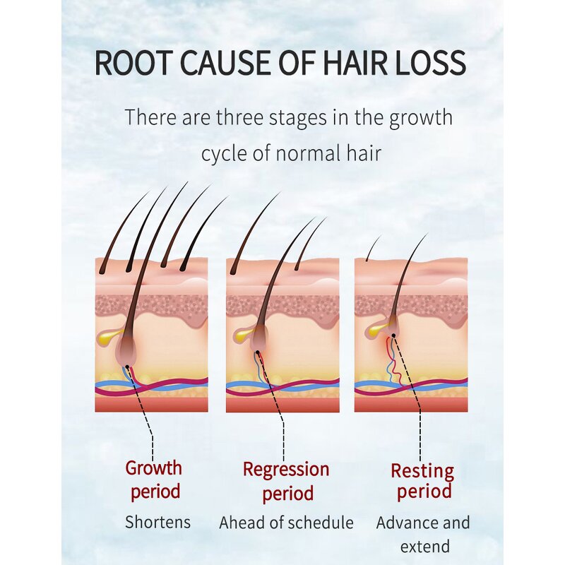 Hair Tonic Lotion Manufacturer - Organic Chinese - Rosemary Oil Essence Serum, Nourishing, Helps Grow Bald Hair Fast