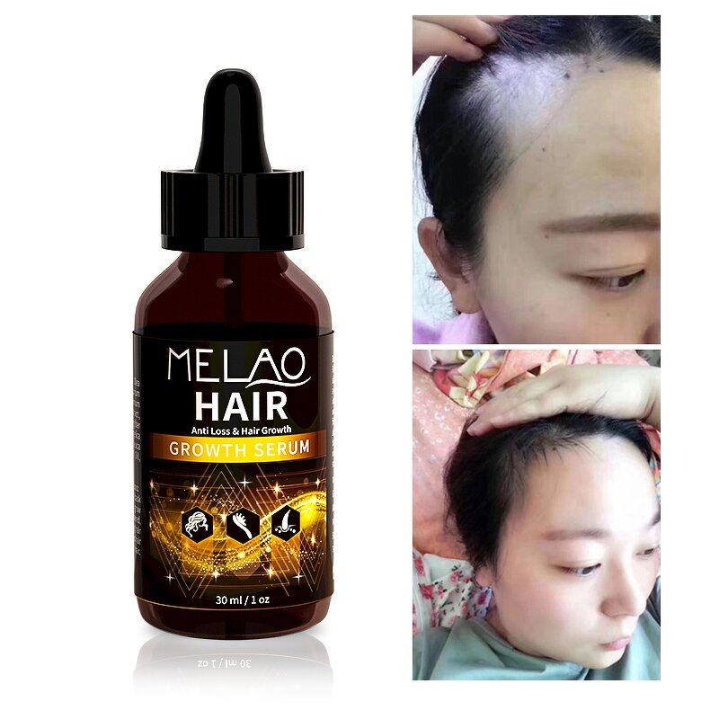 Hair Oil Manufacturer - MELAO Private Label Organic Hair Growth Serum Natural Black Hair Formula