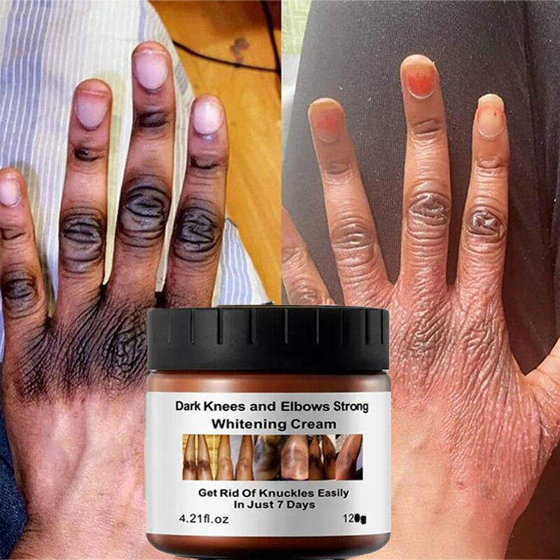 Whitening Cream Manufacturer - New Arrival Niacinamide Dark Knees Knuckles Elbows Armpit Private Parts Bleaching Dark Skin