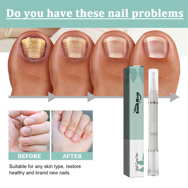 Nail Repair Pen Manufacturer - South Moon Thick Nail Onychomycosis Subungual Edema Fungal Infection Treatment