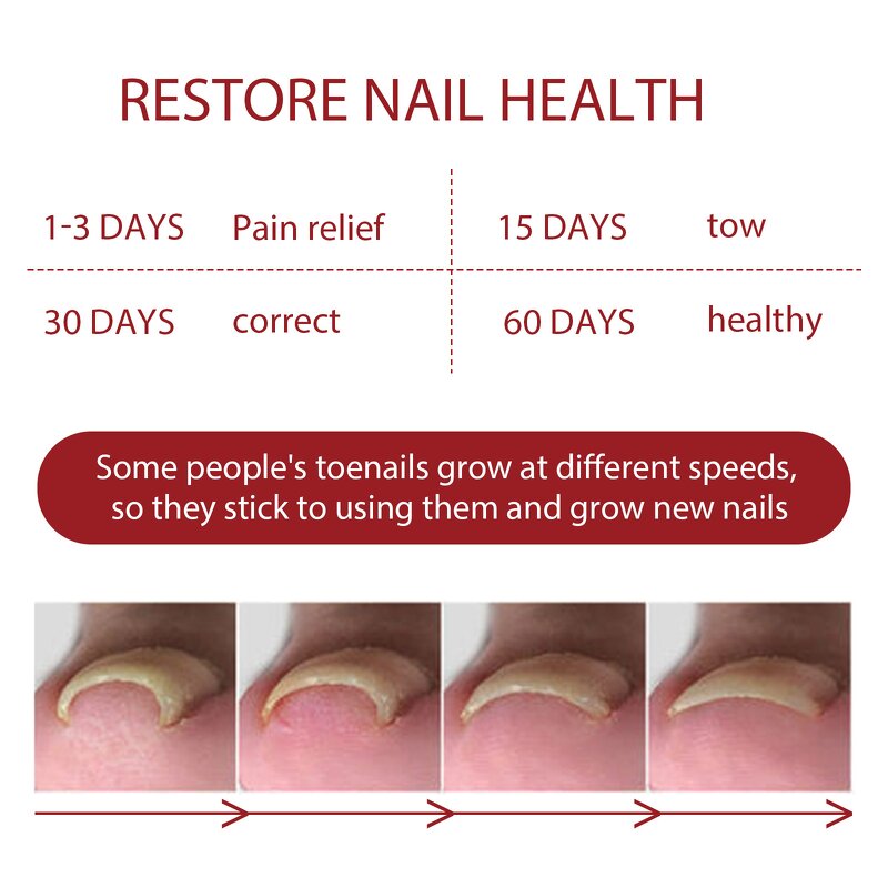 Nail Renewal Liquid Manufacturer - Nail Renewal Extra Strength Fungus Toe Fingernails Repair Damaged Broken 7 Days