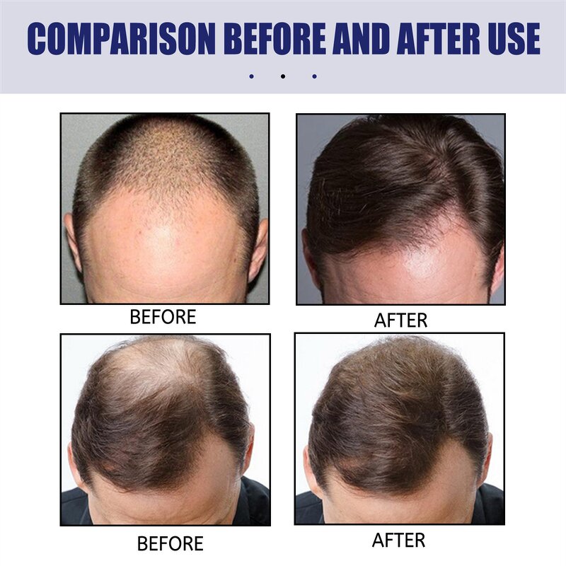 Hair Growth Foam Manufacturer - East Moon Men Deep Repair Hair Root Follicle Promotes Fast Growing Castor Argan Oil