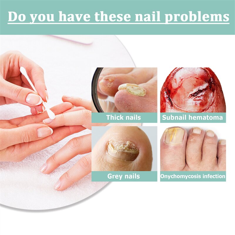 Nail Repair Pen Manufacturer - South Moon Thick Nail Onychomycosis Subungual Edema Fungal Infection Treatment
