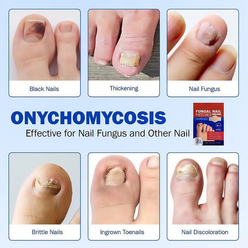 Nail Patches Manufacturer - Best Anti Fungal Nail Treatment Stickers Private Label OEM 8 Hours Overnight Repair