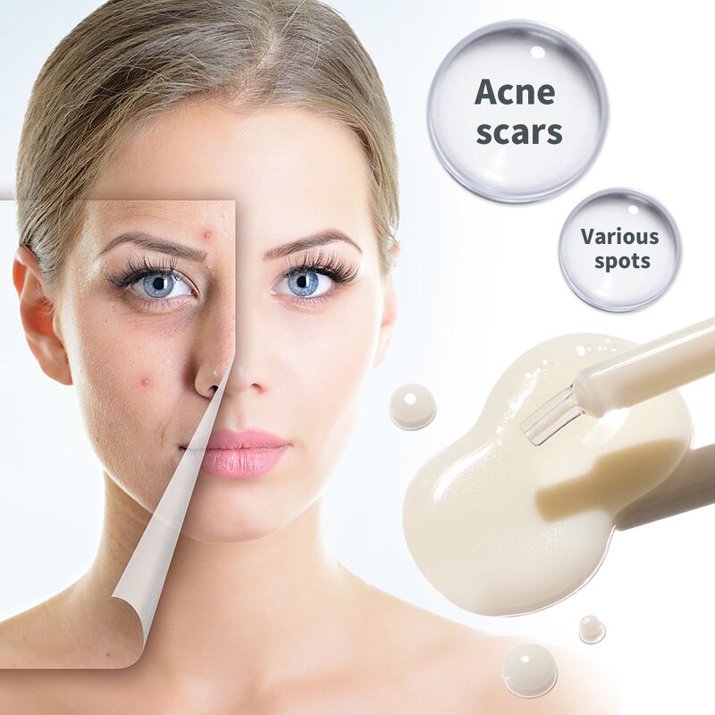 Brightening Essence Manufacturer - Eliminate Various Spot Acne Treatment Moisturizing Skin Anti Wrinkle