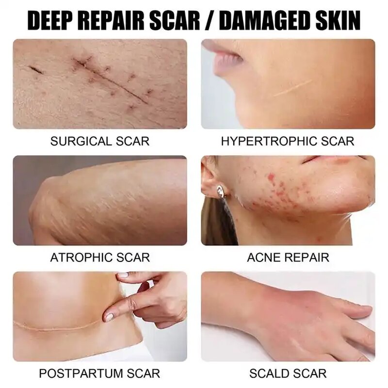 Scar Removal Cream Manufacturer - Fastest Acne Scar Face Care Scar Gel Bruise Repair Tummy Tuck 30g Stretch Mark