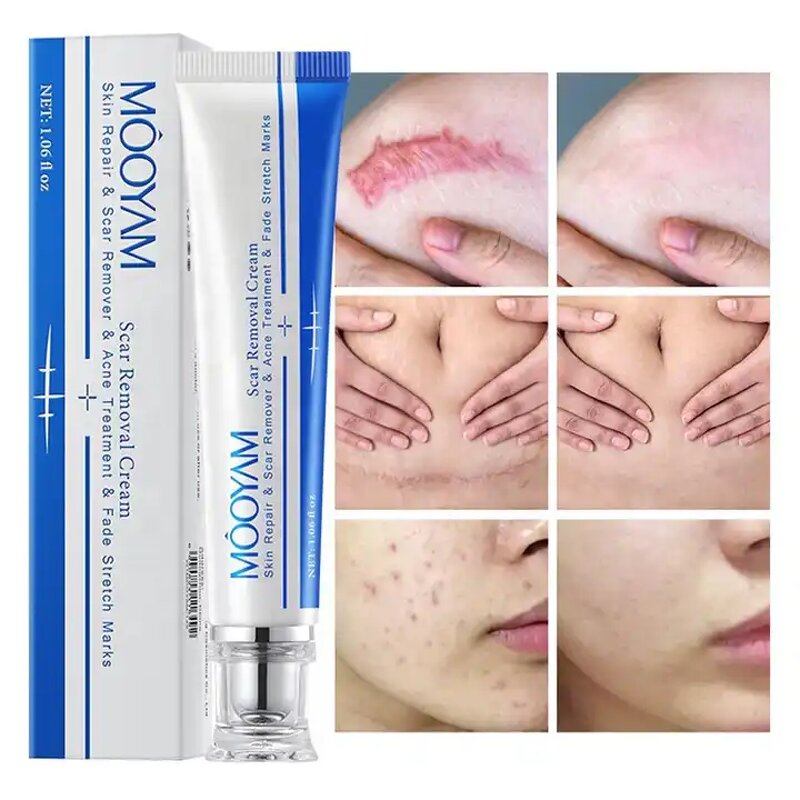 Scar Removal Cream Manufacturer - Fastest Acne Scar Face Care Scar Gel Bruise Repair Tummy Tuck 30g Stretch Mark