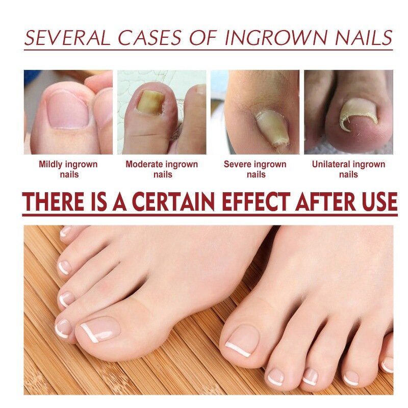 Nail Relief Oil Manufacturer - Wholesale High Quality Nail Removal Essence Toenail Treatment Anti Paronychia Relief