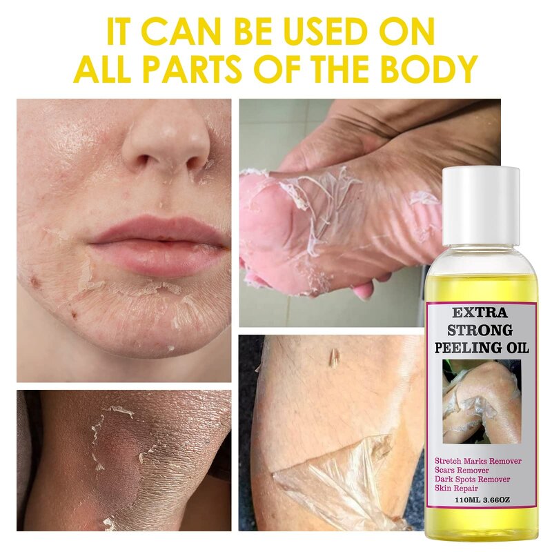 Peeling Oil Manufacturer - Private Label Extra Strong Peeling Oil Scar Remove Stretch Marks Whitening Yellow