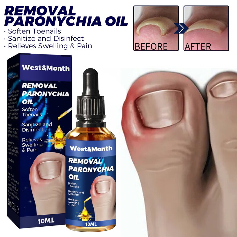Nail Relief Oil Manufacturer - Wholesale WEST MONTH Nail Care Fast Effective Removal Anti Paronychia Relief 10ml