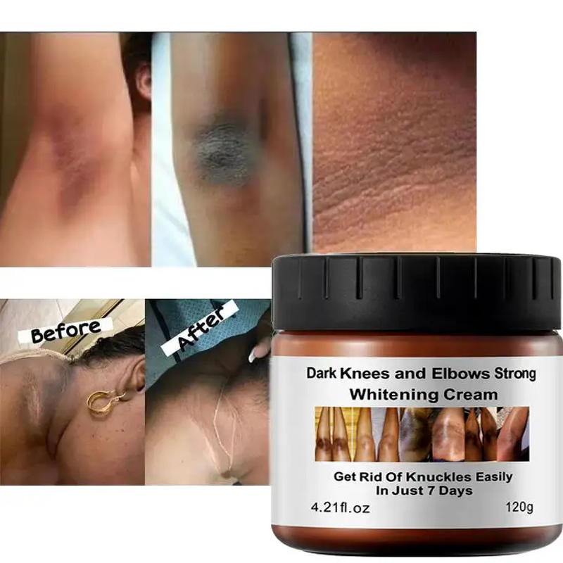 Whitening Cream Manufacturer - New Arrival Niacinamide Dark Knees Knuckles Elbows Armpit Private Parts Bleaching Dark Skin