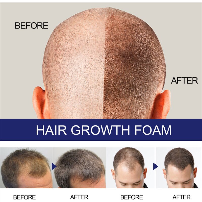 Hair Growth Foam Manufacturer - East Moon Men Deep Repair Hair Root Follicle Promotes Fast Growing Castor Argan Oil