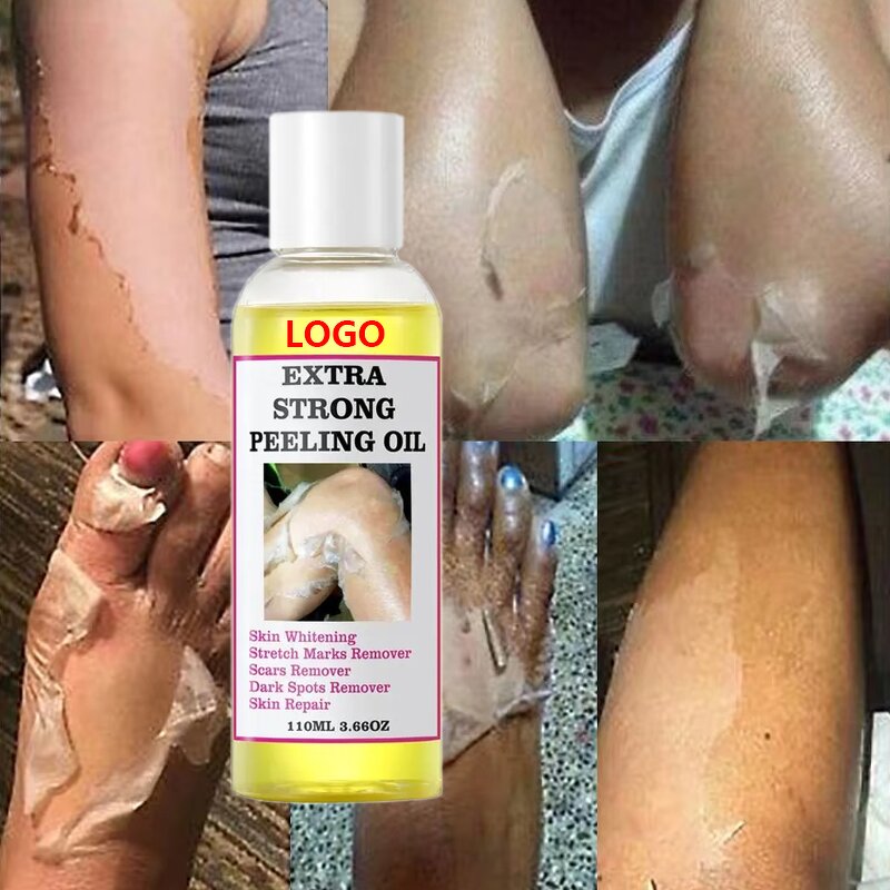 Peeling Oil Manufacturer - OEM Body Skin Care Yellow Dark Spots Removers Strong Knuckle Whitening