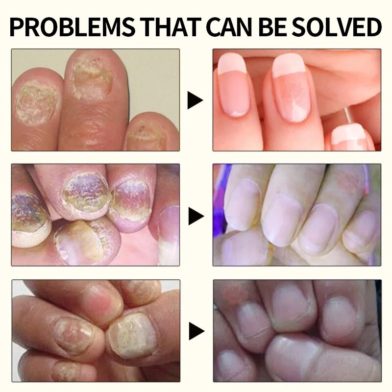 Nail Repair Serum Manufacturer - OEM Manufacturer Wholesale Natural 15ml Anti Bacterial Fungal