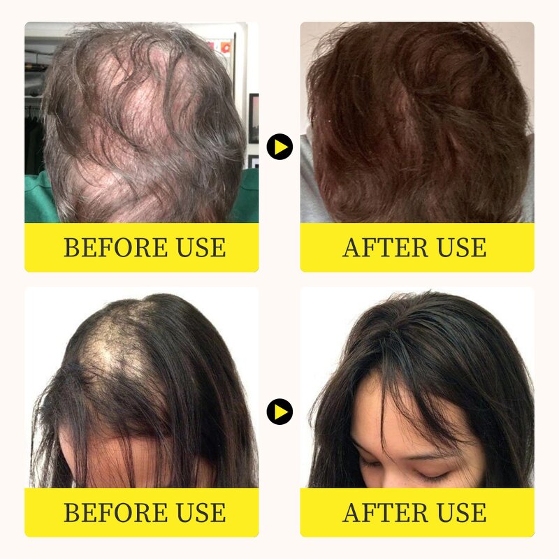Hair Growth Serum Manufacturer - Anti Hair Loss Ginger Oil Regrowth Care Vitamin B5 Biotin Men Women