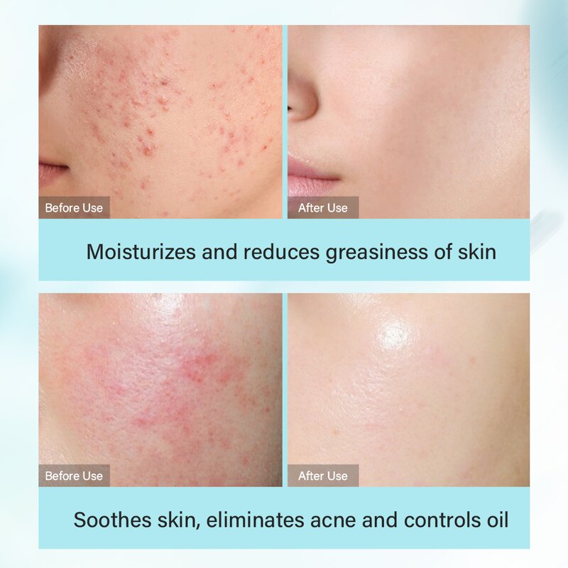 Acne Removal Cream Manufacturer - Tea Tree Salicylic Acid Korean Skincare Facial Anti Acne Anti Aging Set