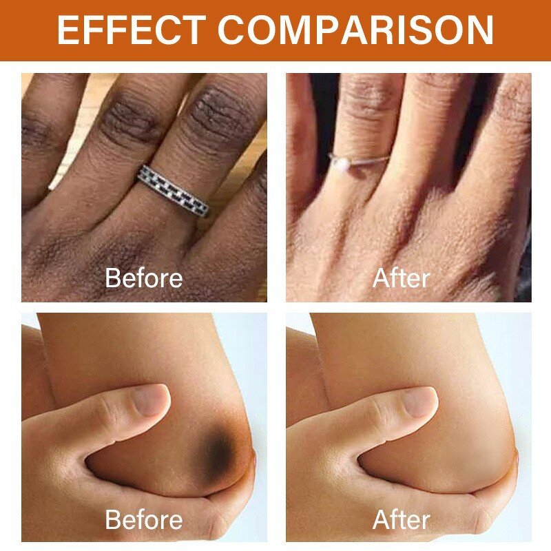 Dark Knuckles Serum Manufacturer - Fast Whitening Hand Knuckle Elbows Knee Stains Remover OEM Private Label