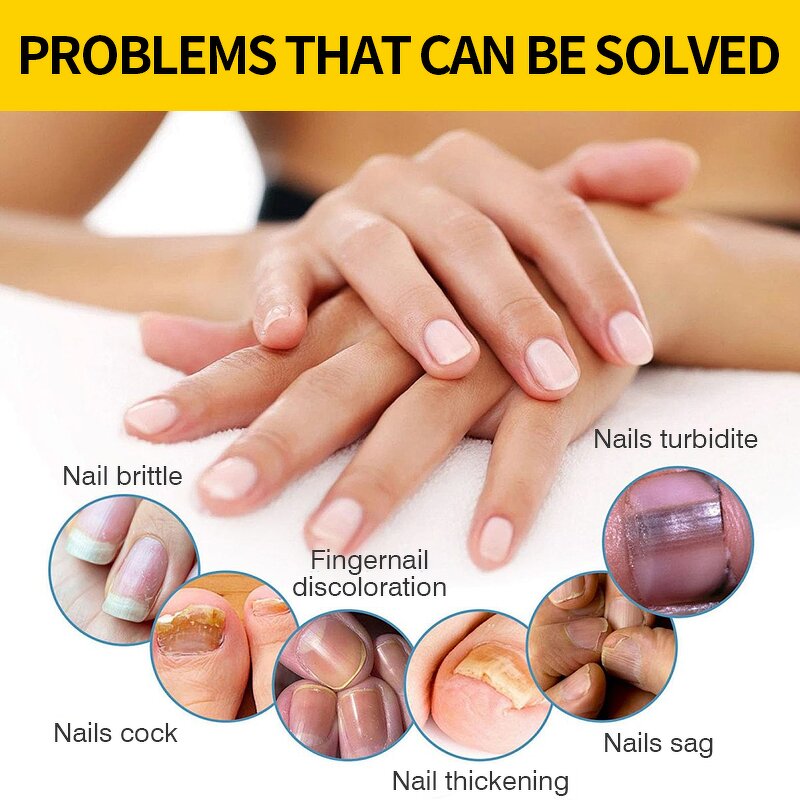 Nail Repair Serum Manufacturer - 15ml Clean Whiten Nourish Fungal Treatment Toe Nail Fungus