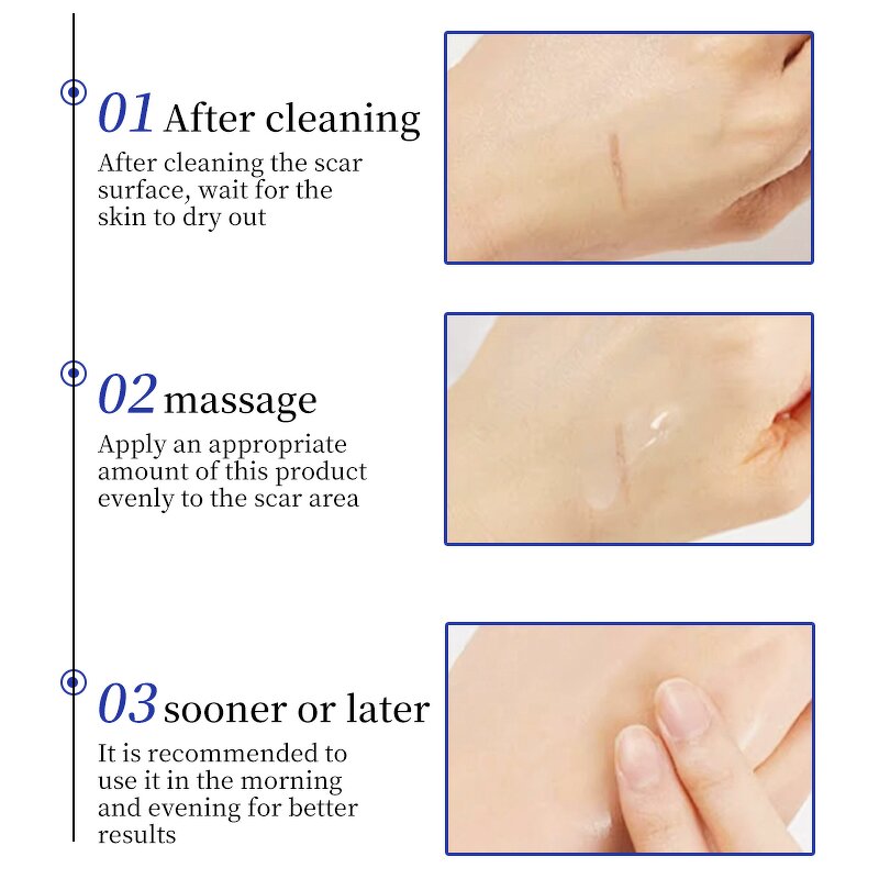 Scar Removal Cream Manufacturer - Silicone for Old Scars Stretch Mark Face Skin Repair Gel