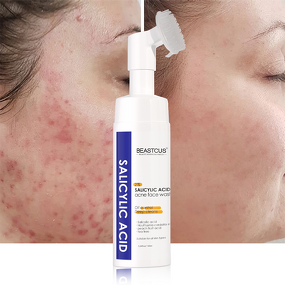 Facial Cleanser Manufacturer - Factory Price Acne Control - Bubble Salicylic Acid Skin