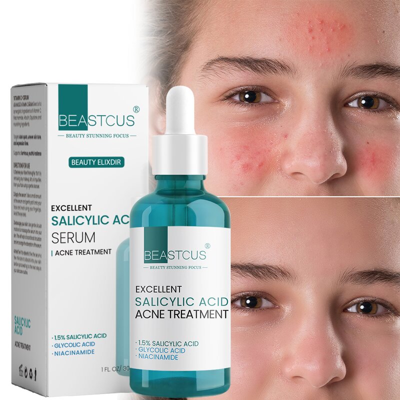 Acne Treatment Serum Manufacturer - Niacinamide Glycolic Acid 1.5% - Salicylic Acid