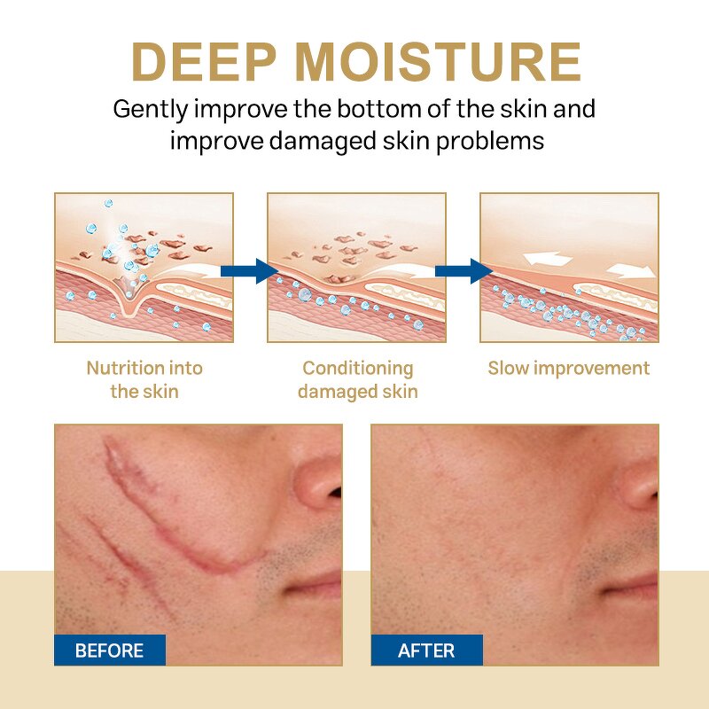 Peeling Oil Manufacturer - OEM ODM Custom Extra Strong for Body Skin Whitening Stretch Marks Remover