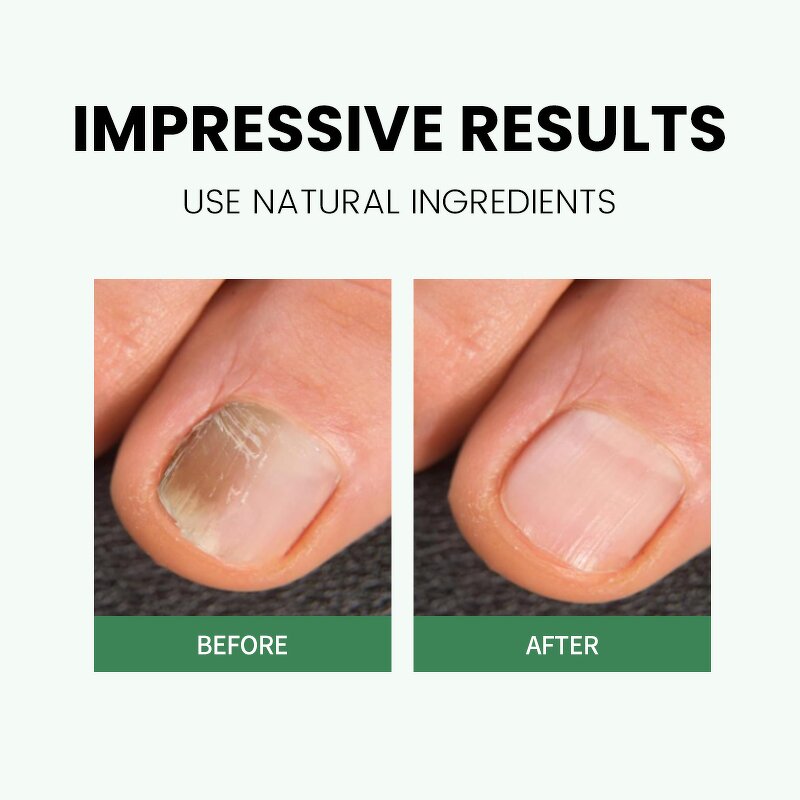 Nail Care Pen Manufacturer - OEM Custom Cuticle Repair for Foot Finger Nails - Private Label