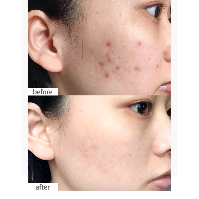 Face Serum Manufacturer - Salicylic Acid Acne Care Pimple Moisturizing Face Serum Organic Skincare Products