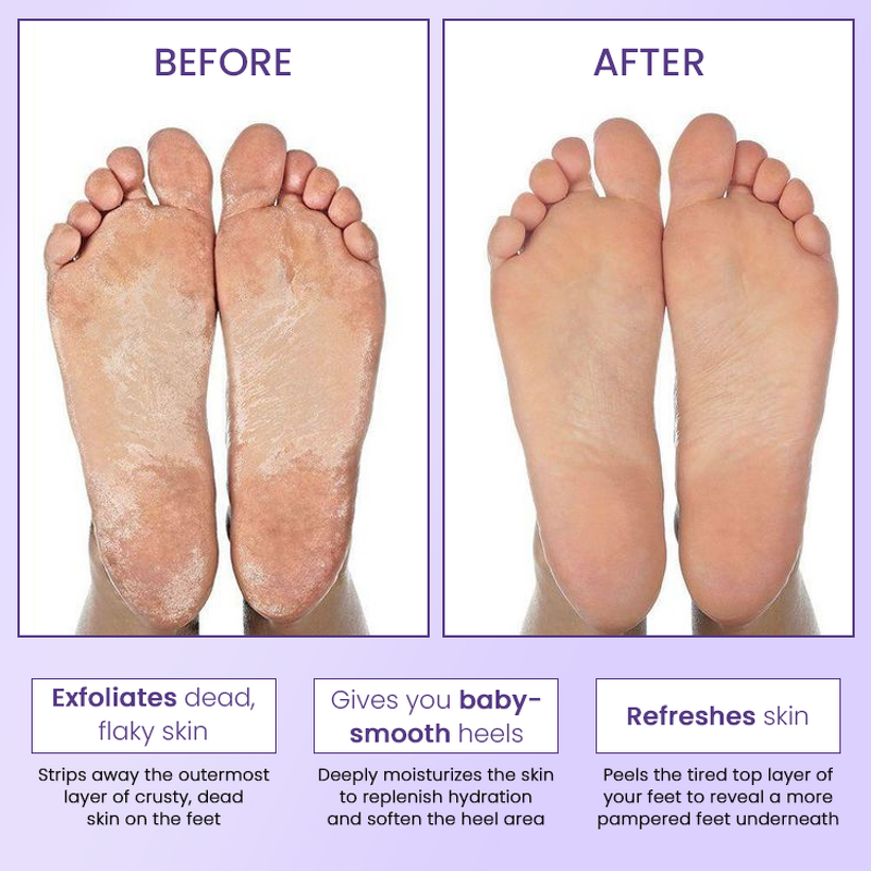 Foot Exfoliator Manufacturer - Lactic Acid Salicylic Acid - Kojic Acid Reduces Water Loss Inhibits Melanin