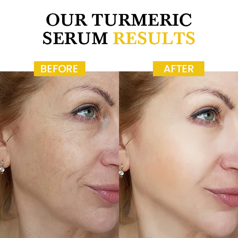 Serum Manufacturer - Anti Acne Turmeric - Organic Vegan Reduces Inflammation Wrinkles Brightening Repair