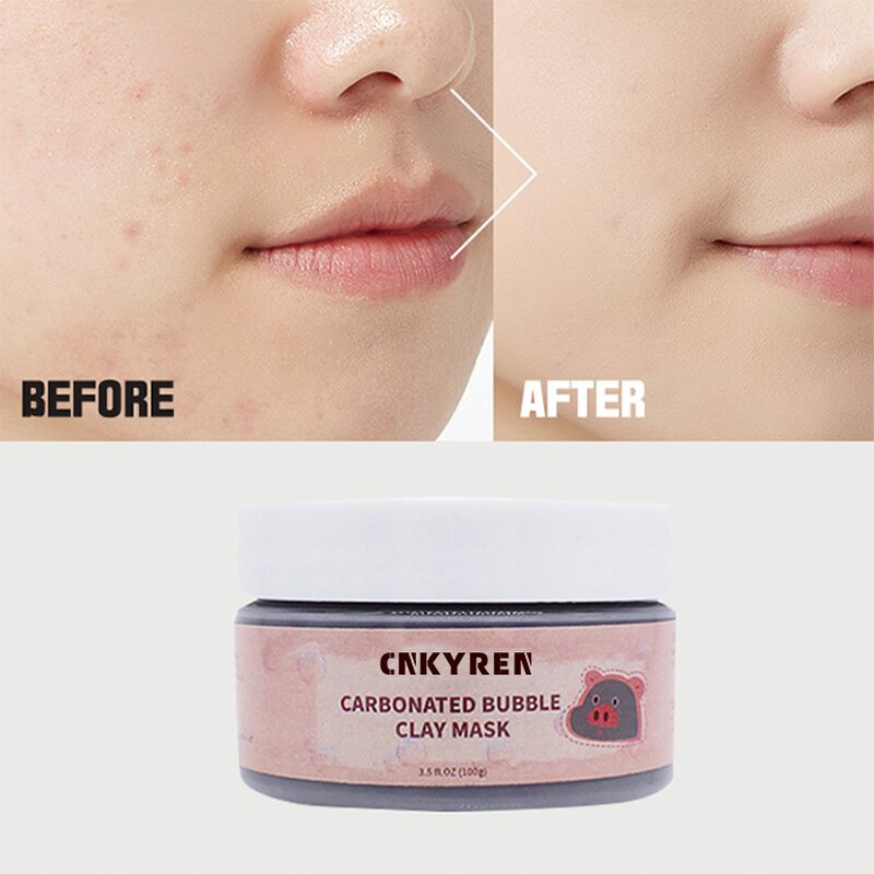 Facial Mask Manufacturer - OEM Carbonated Bubble - Anti Acne Anti Wrinkle Pore Cleaner Collagen Hyaluronic Acid