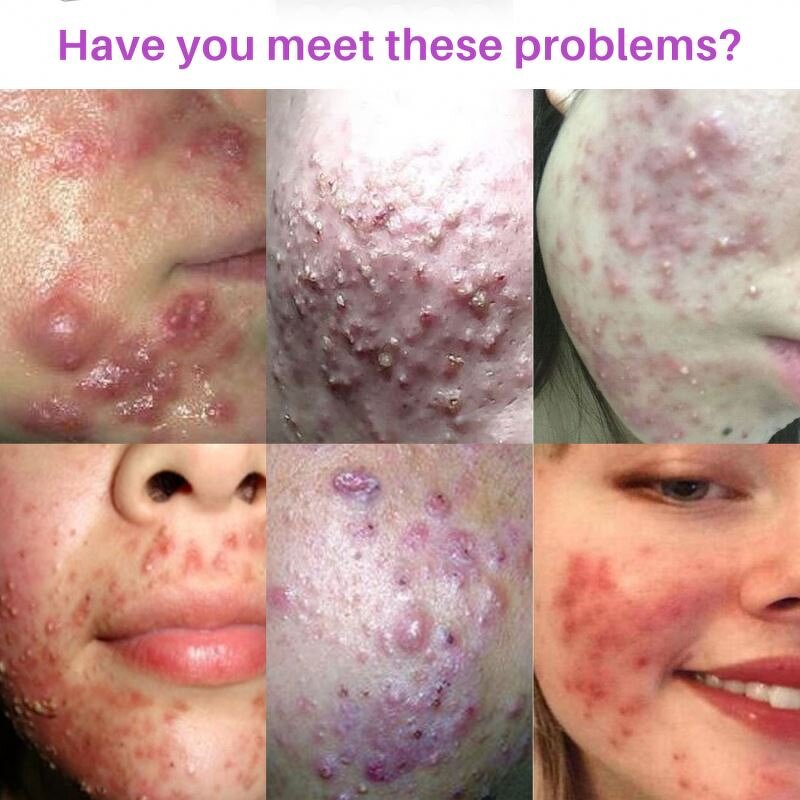 Acne Patches Manufacturer - OEM ODM Medical Grade Acne Treatment Waterproof Transparent Invisible Facial