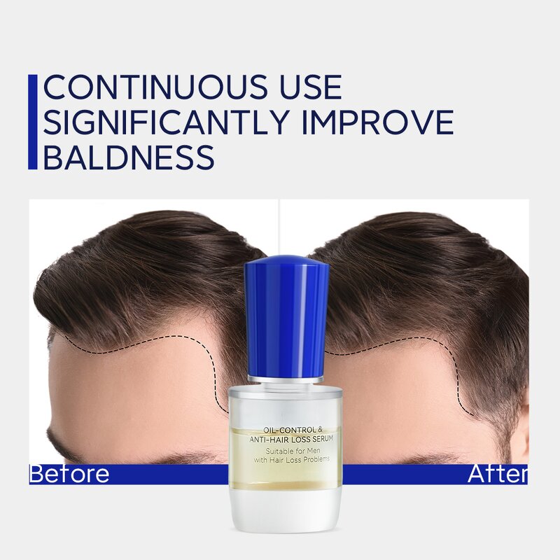 Anti-hair Loss Set Manufacturer - Wholesale Nattiguard with Keratin & Adenosine Oil Control for Man