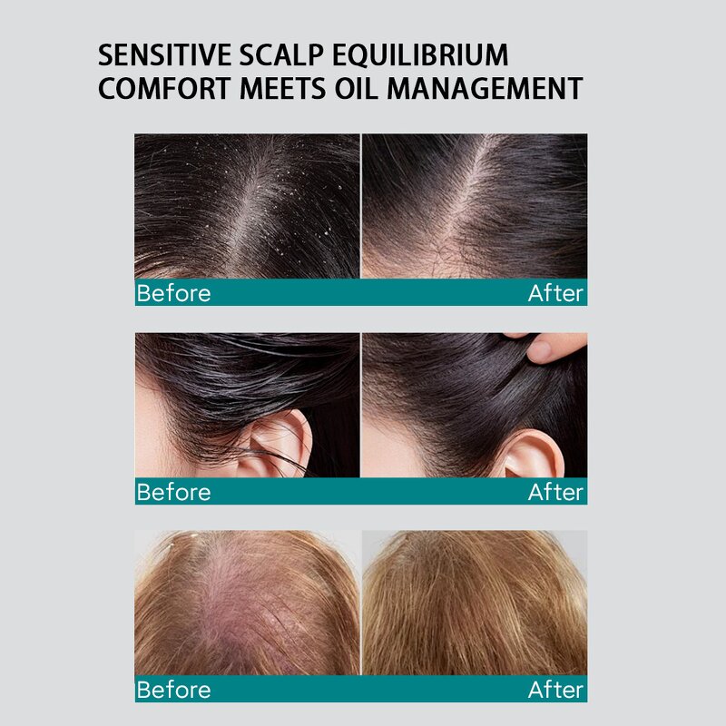 Scalp Serum Manufacturer - High Quality Nattiguard Instant Oil Control with Sodium Salicylate
