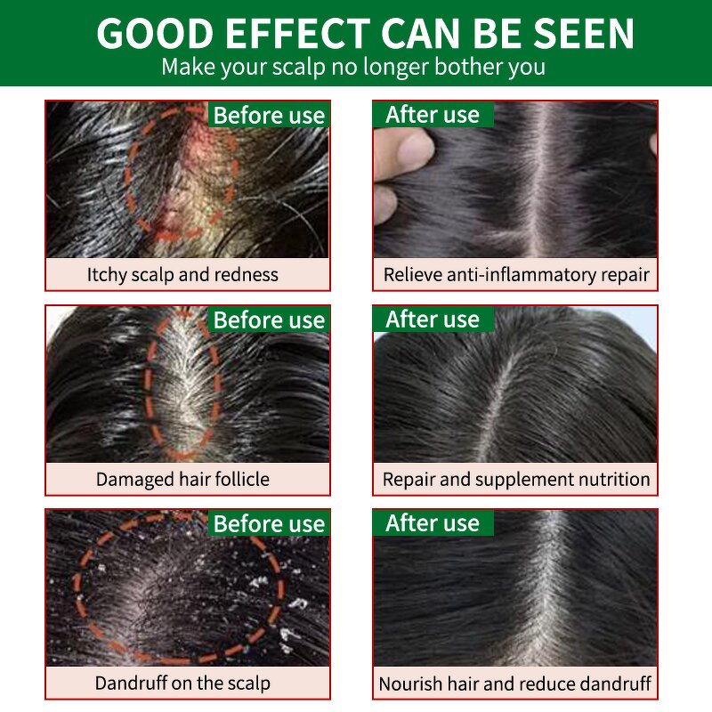 Hair Growth Spray Manufacturer - OEM 20ml Concentrated Formula Natural Herbal Women Men Hair Loss Treatment