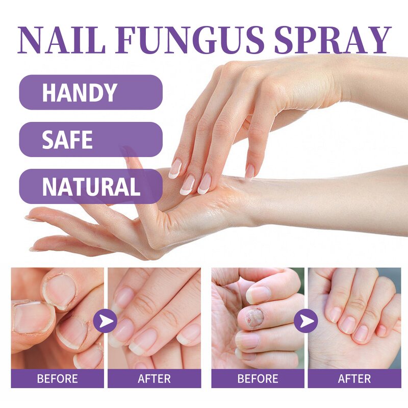 Gray Nail Spray - OEM 100ml Plant Extract Fungus Nail Care Odor Clean
