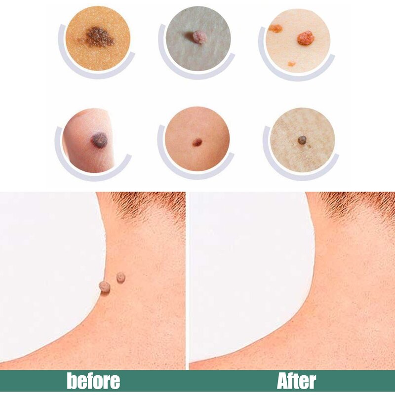 Skin Tag Wart Cream - OEM Herbal Extract Flesh Thorn Corn Removal Wholesale