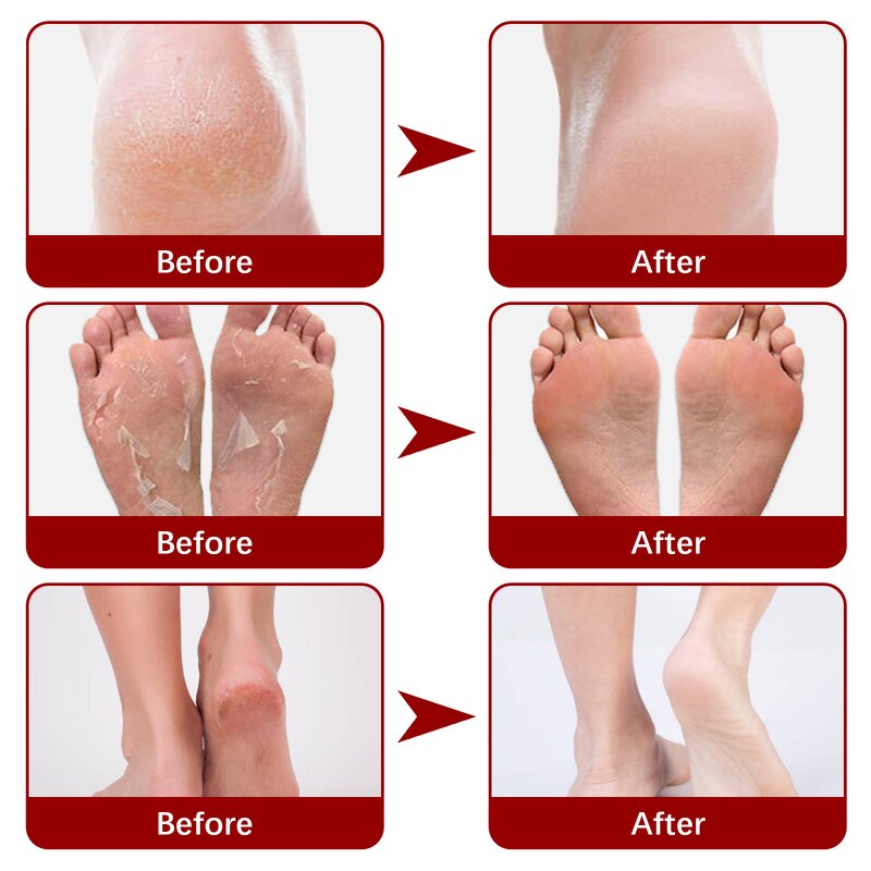 Foot Mask Manufacturer - OEM Fruit Acid Exfoliating Calluses Dead Skin Remover