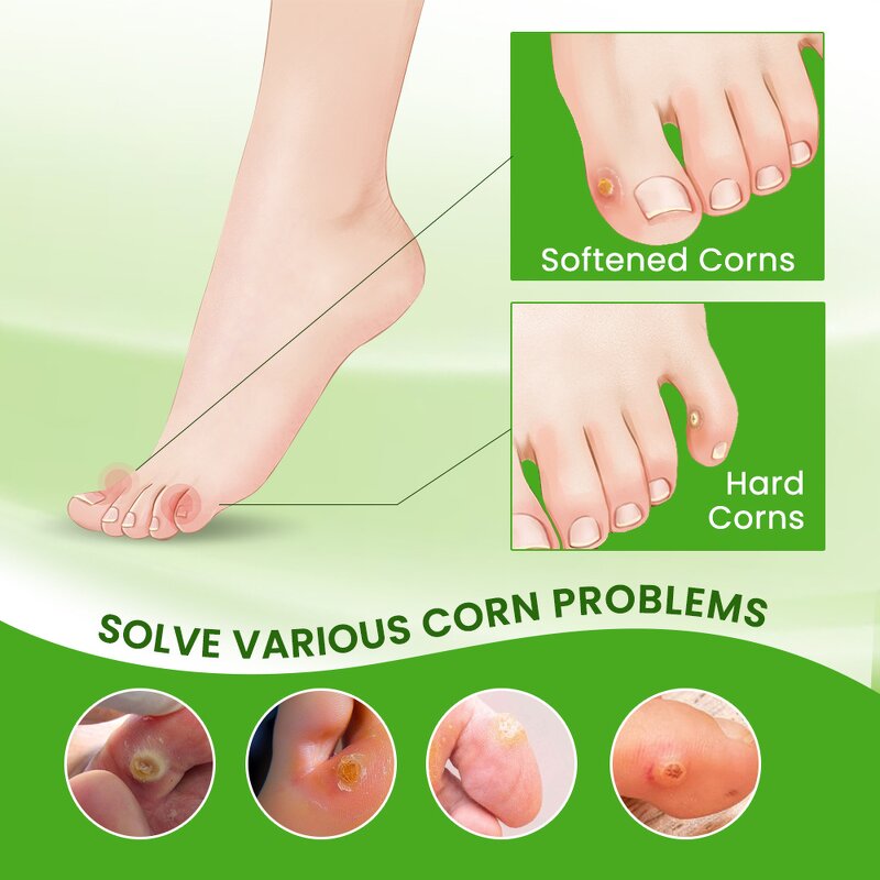 Foot Corn Cream - OEM 30G Chicken Eye Dead Skin Calluses Treatment Cream