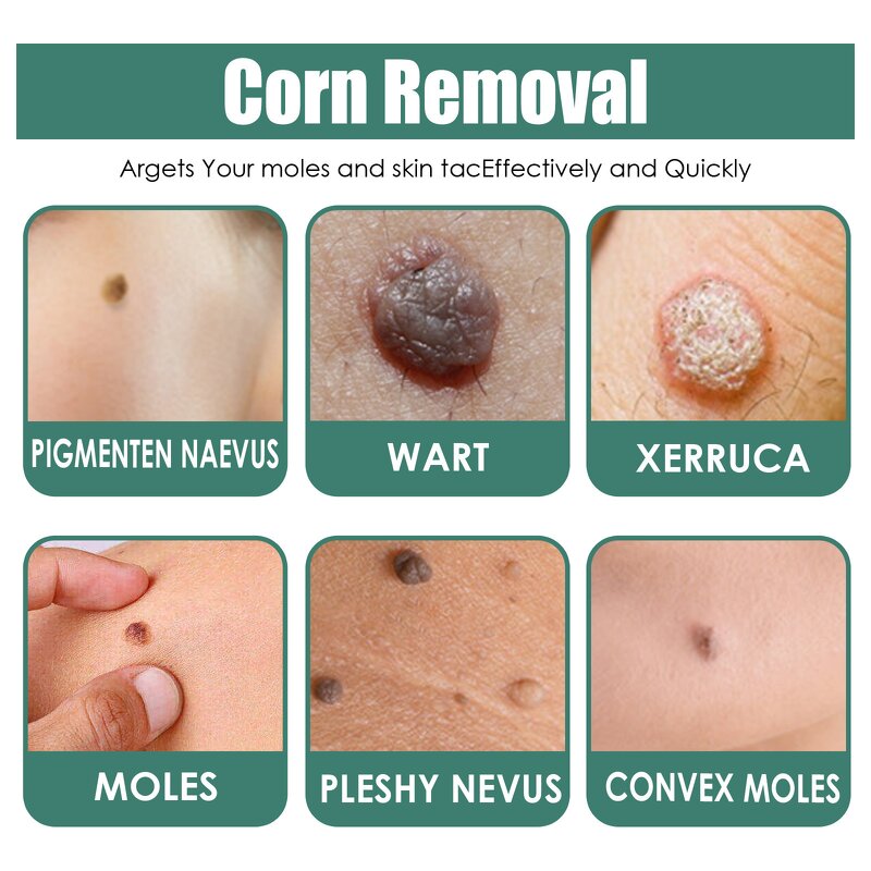 Skin Tag Wart Cream - OEM Herbal Extract Flesh Thorn Corn Removal Wholesale
