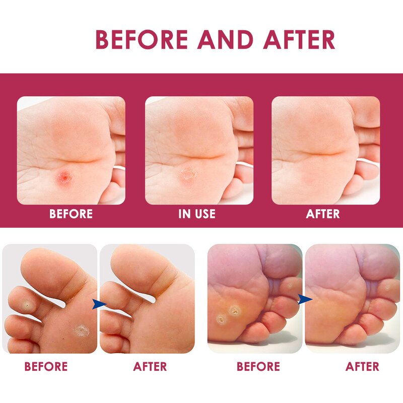 Corn Removal Pads - OEM 10 Patches Medical Foot Care Calluses Remover