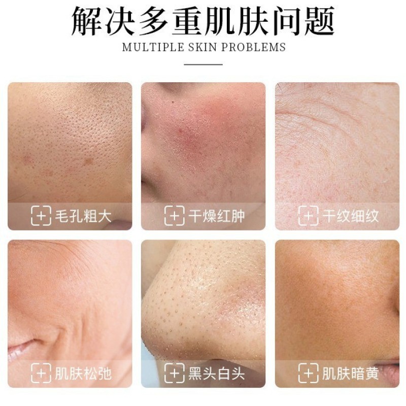 Hydra Facial Machine Supplier - Jet Peel Diamond Oxygen 17 in 1