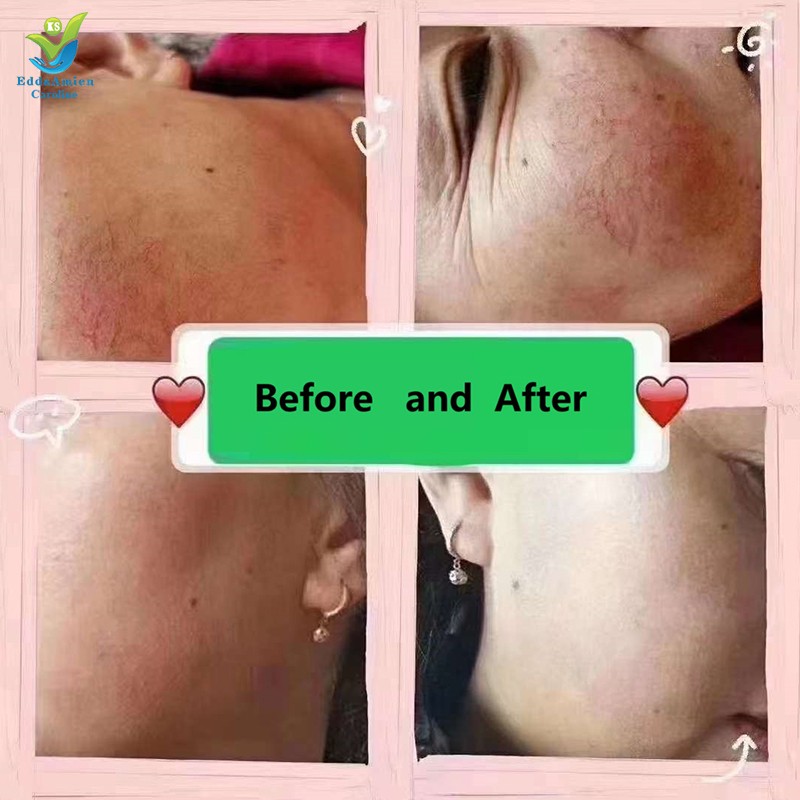 Vascular Removal Machine Factory - 980 nm Diode Spider Veins