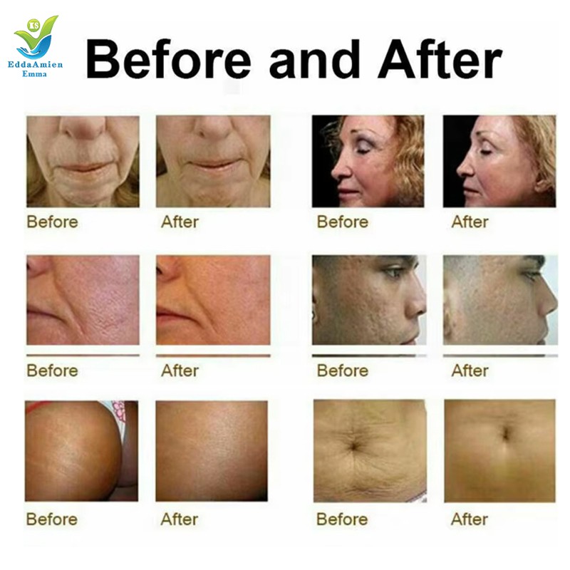 RF Face Machine Factory - Portable Gold Fractional Needles