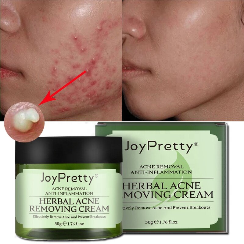 Tea Tree Acne Cream - Manufacturer - OEM Private Label Centella Oil Control Anti Acne Pimple Removal Cream