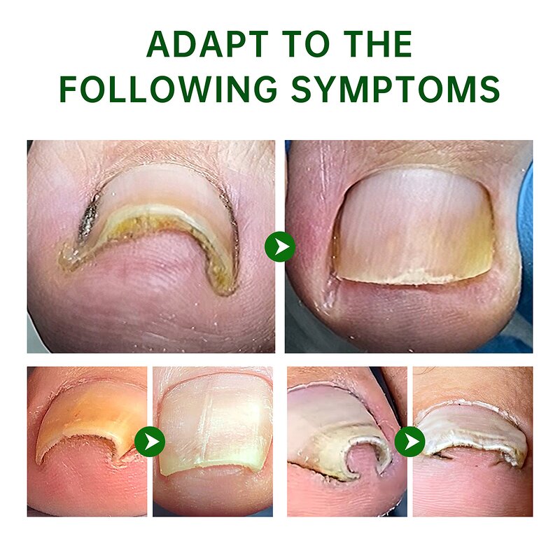 Nail Repair Oil Gel - Manufacturer - Private Label Anti Infection Paronychia Onychomycosis Feet Care Gel