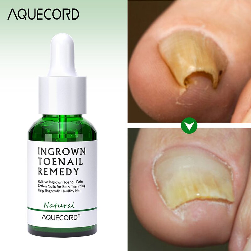 Nail Repair Oil Gel - Manufacturer - Private Label Anti Infection Paronychia Onychomycosis Feet Care Gel