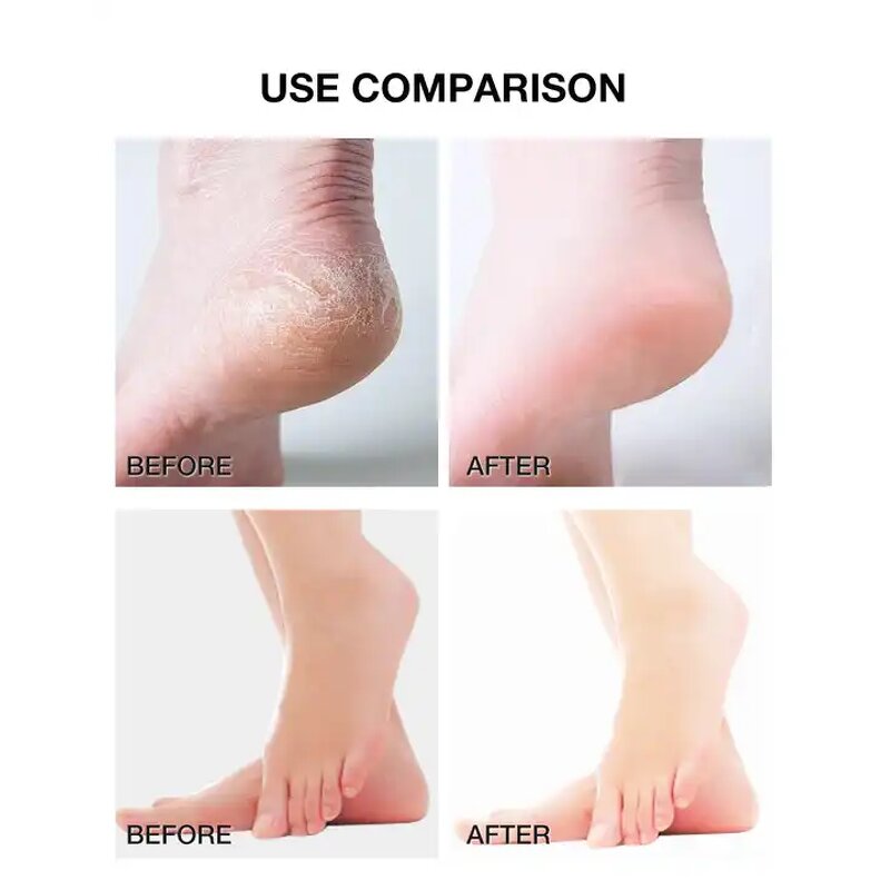 Urea Foot Cream - Manufacturer - Wholesale Private Label Organic 40% Hydrating Cracked Dry Skin Care