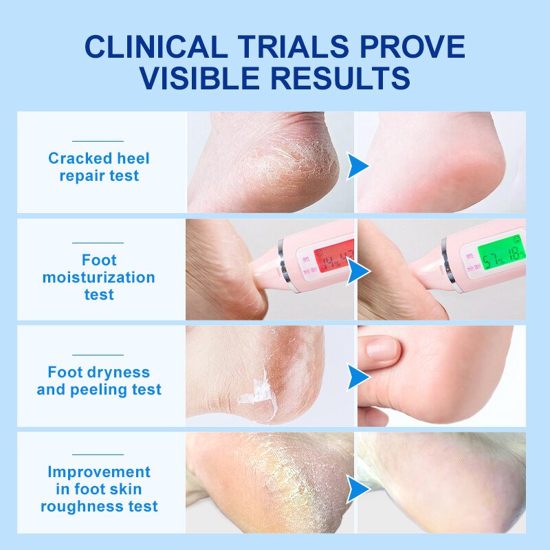 Urea Foot Cream - Manufacturer - Wholesale Organic 40% Relieve Peeling Improve Chapping Dryness Repair