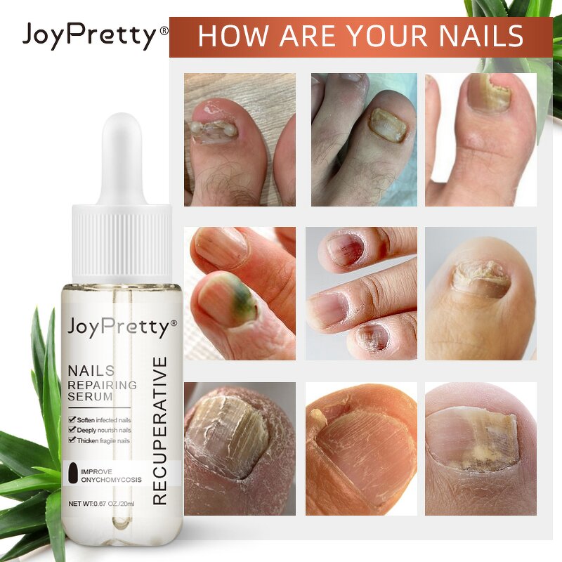 Fungal Nail Repair Serum - Manufacturer - Ready to Ship Remove Onychomycosis Toe Nourishing Nail Serum
